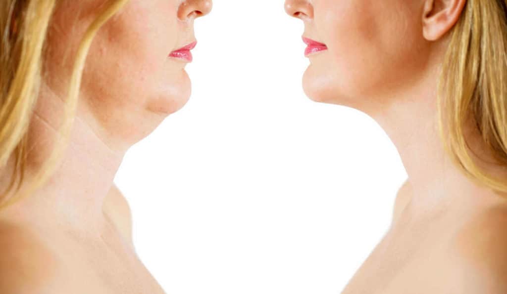 Double Chin treatment Upton before and after results
