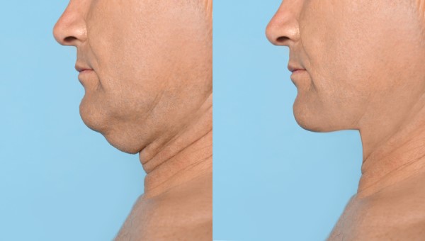 Which Non-Surgical Treatments Work Best for Jowls and Loose Skin Upton?