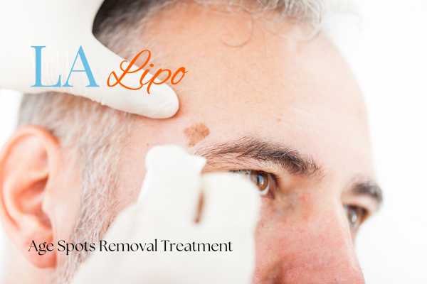 What Are the Most Effective Treatments for Age Spots Upton?