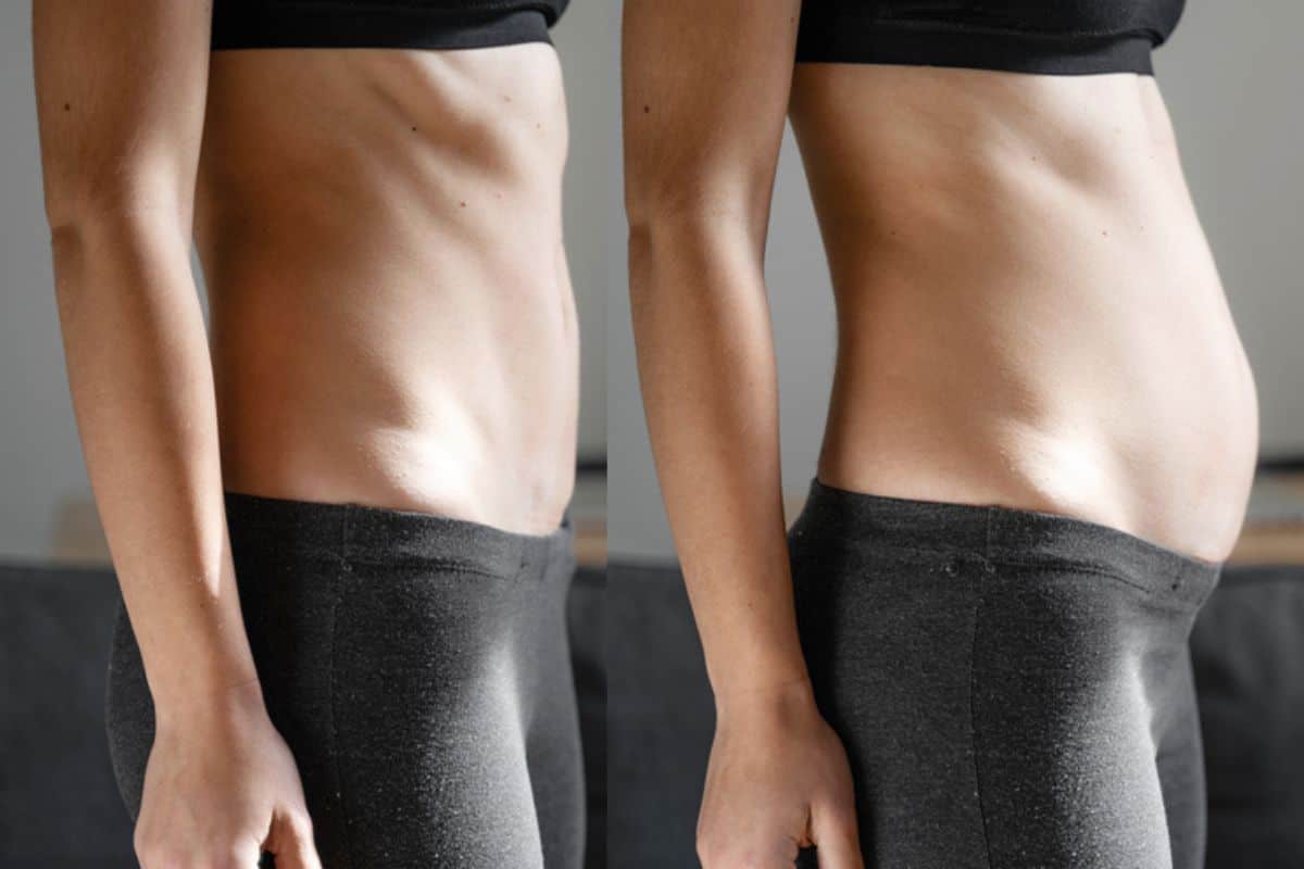 How long does diastasis recti take to improve Upton?