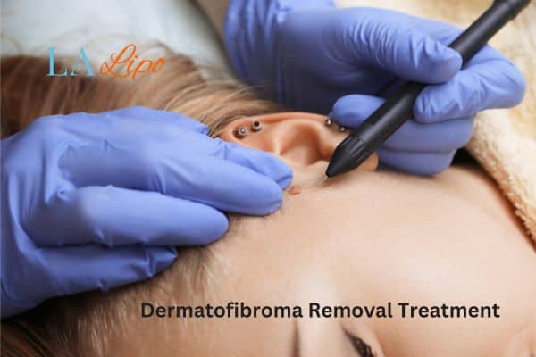 Dermatofibroma Removal Treatment Upton