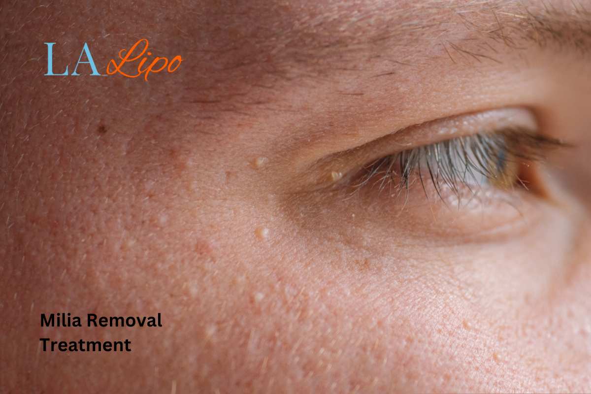 Cryopen Milia Removal: Is It the Easiest and Safest Option Upton?