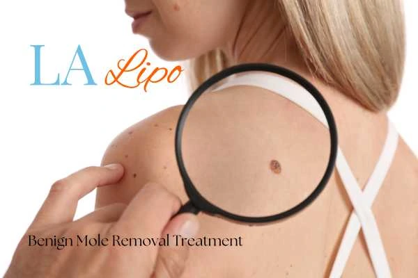 Woman having her inspection of blemish before mole removal Upton