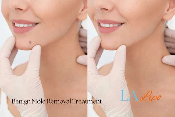 Before and after mole removal Upton treatment