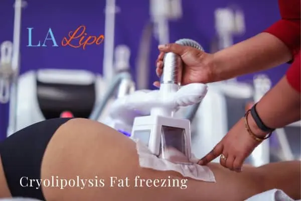 women getting fat freezing Upton