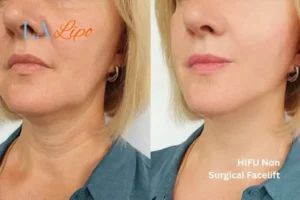 hi-fu for wrinkles Upton before and after results