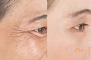 Before and after results of woman - HI-fu wrinkles reduction treatment Upton