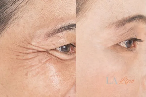 Before and after results of woman - HI-fu wrinkles reduction treatment Upton