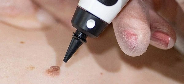 skin tag removal using cryopen Upton