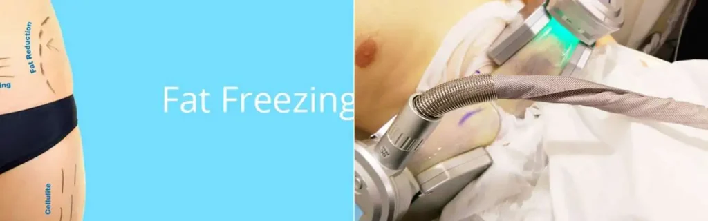 Fat freezing Upton on multiple areas of the body
