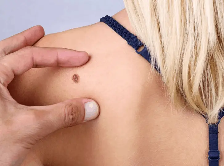 woman having mole removal Upton consultation before treatment.