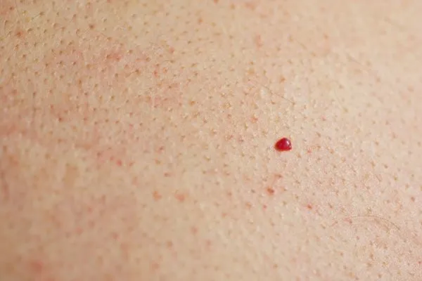 close up of a cherry angioma Upton