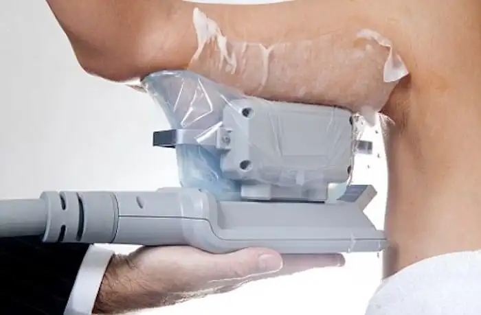 Picture of fat freezing Upton on the upper arms.