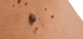 image of a skin tag Upton