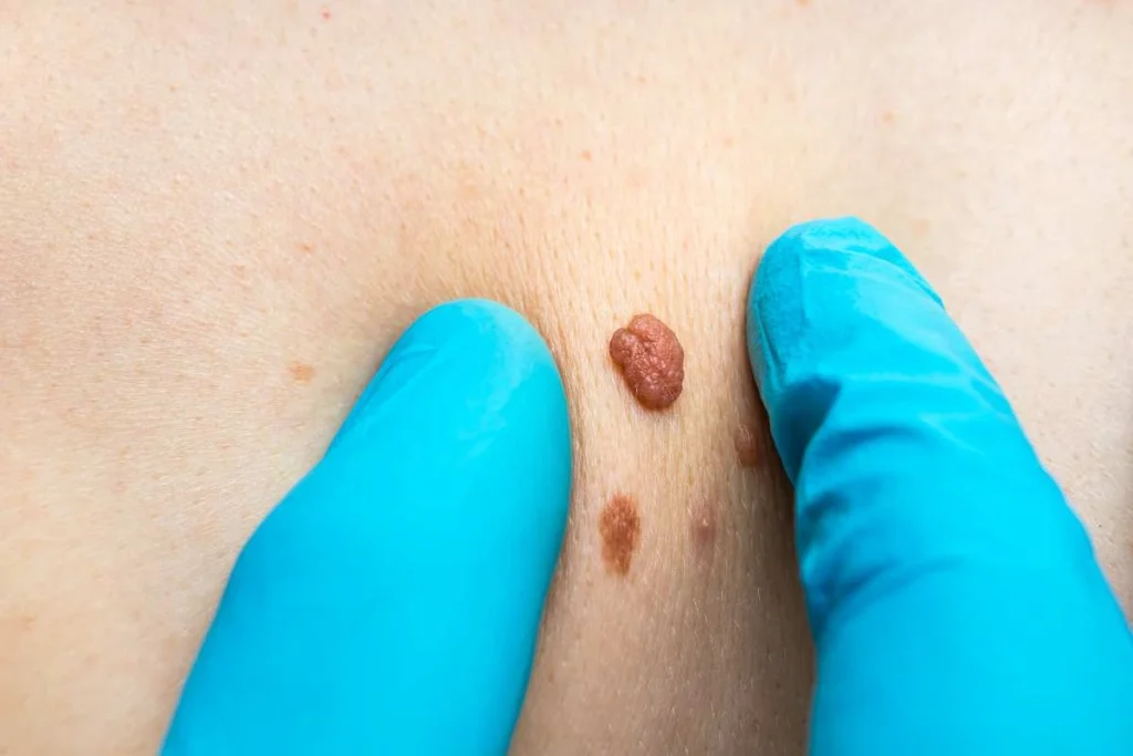 Consultant examining a skin tag Upton