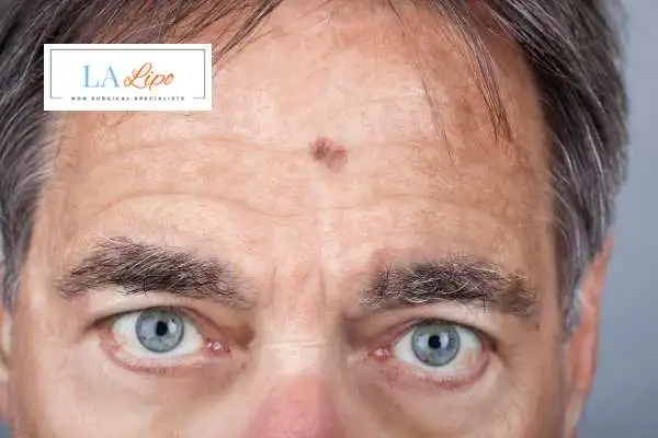 Solar Lentigo Removal Upton image of man with mark on his forehead