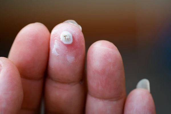 wart on person finger - cryotherapy to treat from LA LIPO Upton