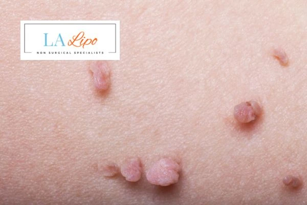 Does cryopen skin tag removal Upton hurt? Find out now call our team today!