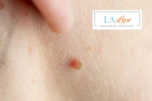 Book skin tag removal Upton today speak to our team now!