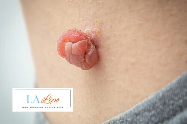 Interested in skin tag removal Upton? Concerned about the pain? Find out more today!