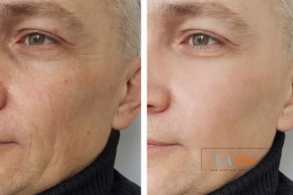 See the amazing results of Morpheus8 Treatment Upton!