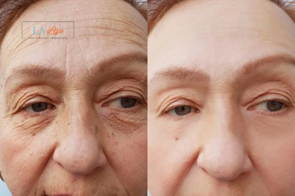 The powerful benefits of Morpheus8 Treatment Upton - Call Our team today!