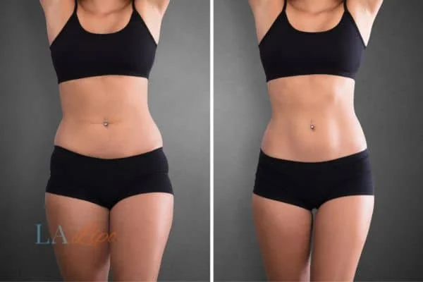 before and after results of non-surgical treatment to help a woman's body image and mental health Upton