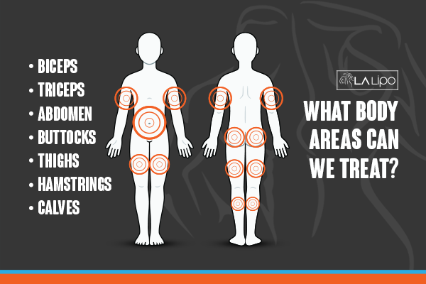 Diagram to show areas you can have LA-EMS Body Sculpting Treatment Upton