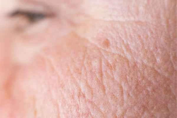 close up picture of a woman's face showing an age spot Upton
