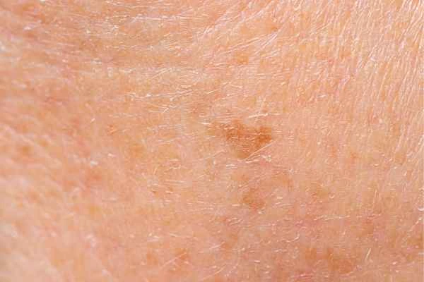 close up picture of age spots Upton