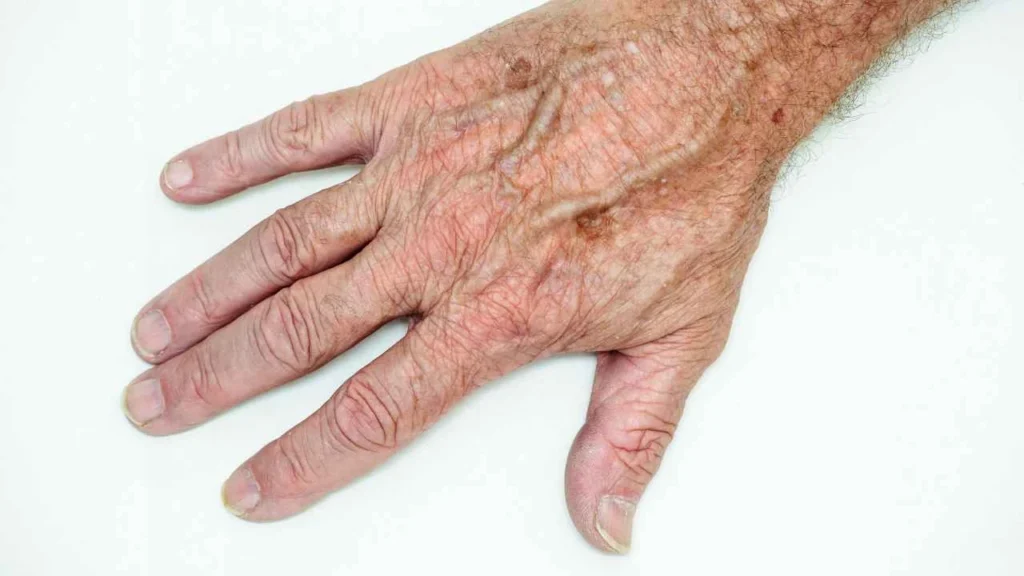 Male hand showing age spot Upton