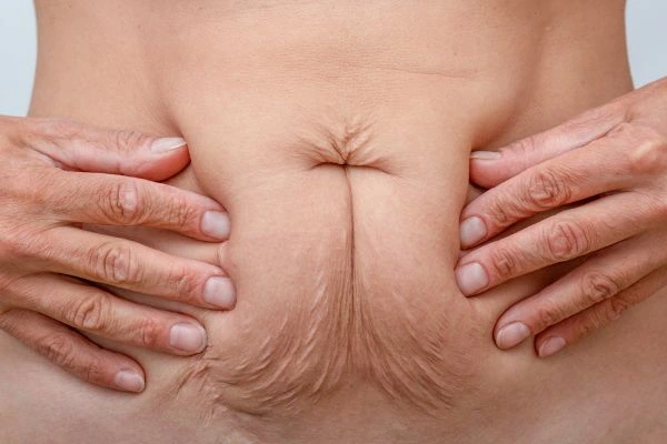 Should I Combine Diastasis Recti Treatment with Body Contouring for Better Results Upton?