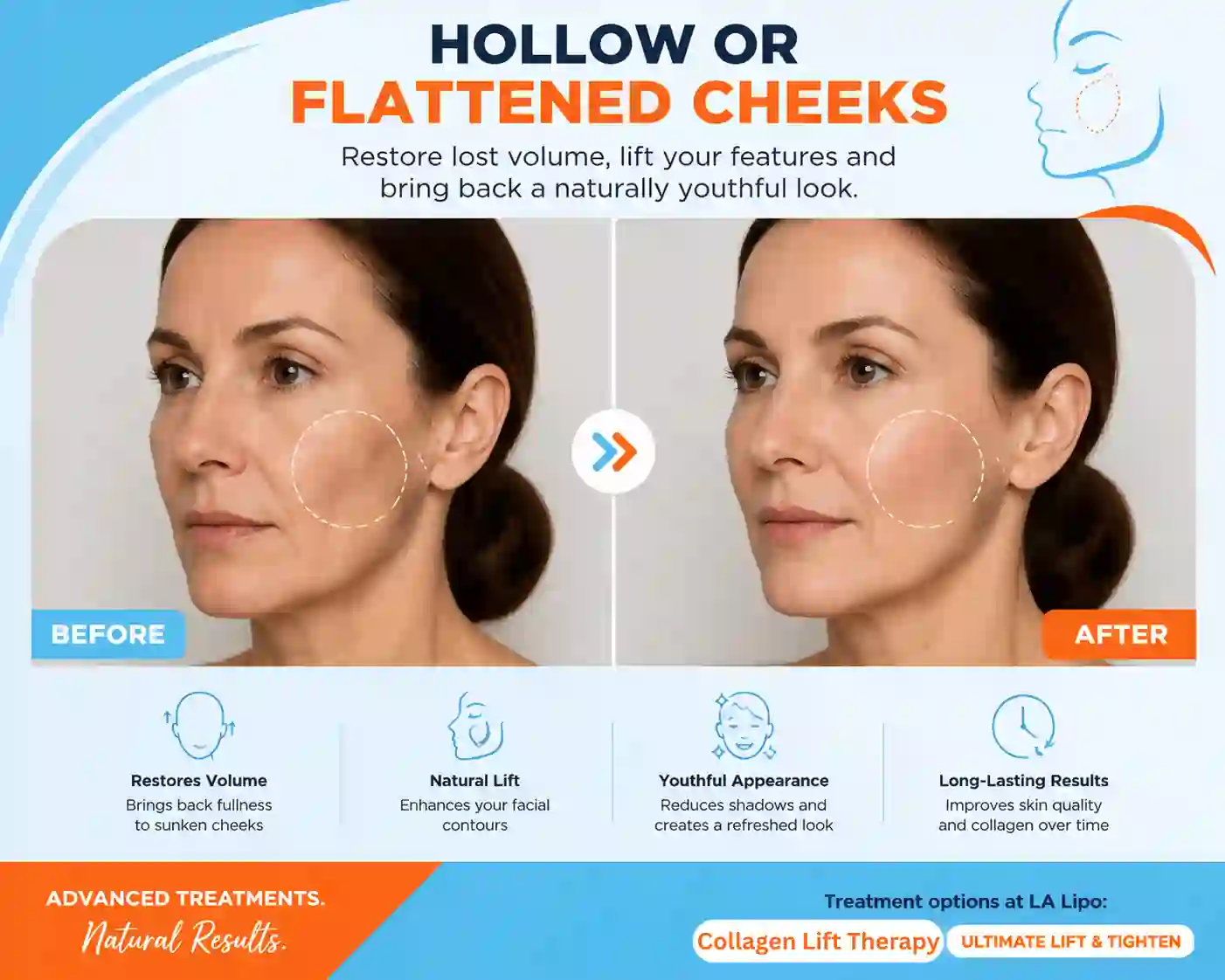 Sign #4: Hollow or Flattened Cheeks Upton
