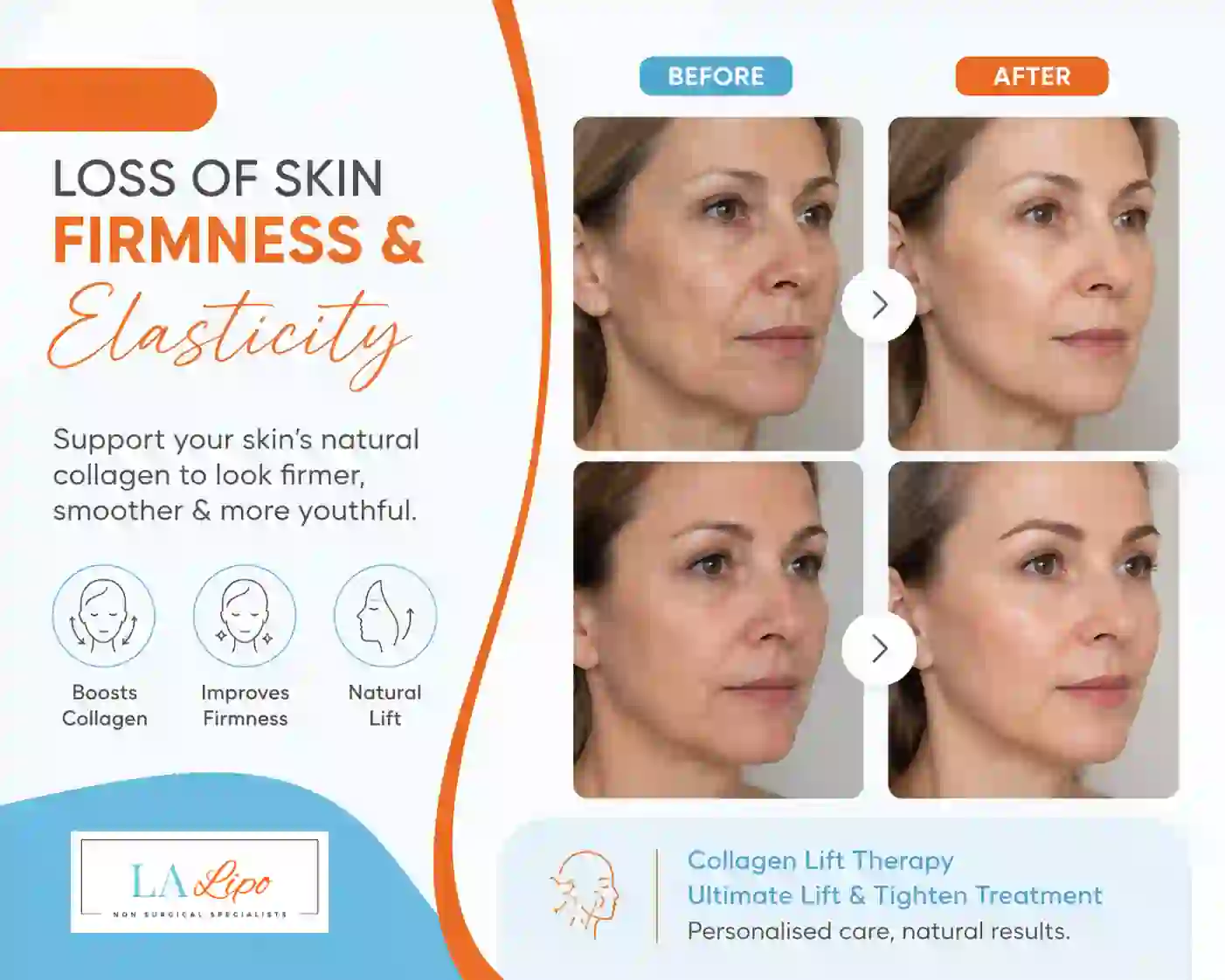Sign #7: Loss of Skin Firmness and Elasticity Upton