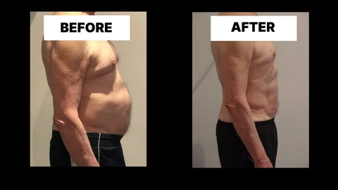 What Symptoms Can Diastasis Recti Cause in Men? Weak Core, Back Pain and Poor Posture Upton